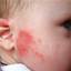 3. Eczema in infants Pictures