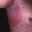 2. Eczema Armpits Pictures
