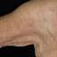 4. Eczema Armpits Pictures