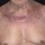 10. Eczema on the Neck Pictures