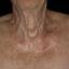 11. Eczema on the Neck Pictures
