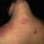 2. Eczema on the Neck Pictures