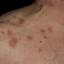4. Eczema on the Neck Pictures