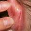 11. Eczema on the Ears Pictures