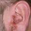 2. Eczema on the Ears Pictures