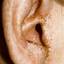3. Eczema on the Ears Pictures