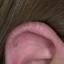 4. Eczema on the Ears Pictures