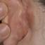 5. Eczema on the Ears Pictures