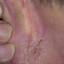 6. Eczema on the Ears Pictures
