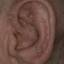 7. Eczema on the Ears Pictures