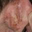 8. Eczema on the Ears Pictures