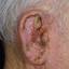 9. Eczema on the Ears Pictures