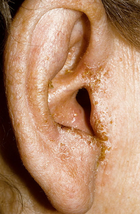 ear eczema pictures