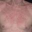 1. Eczema on the Body Pictures