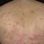10. Eczema on the Body Pictures