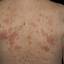 11. Eczema on the Body Pictures