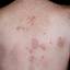 12. Eczema on the Body Pictures