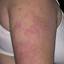 13. Eczema on the Body Pictures