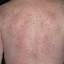 14. Eczema on the Body Pictures
