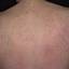 17. Eczema on the Body Pictures