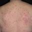 18. Eczema on the Body Pictures