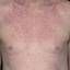 2. Eczema on the Body Pictures