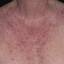 20. Eczema on the Body Pictures