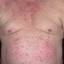 21. Eczema on the Body Pictures