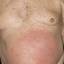 23. Eczema on the Body Pictures