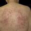 25. Eczema on the Body Pictures