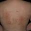 27. Eczema on the Body Pictures