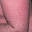33. Eczema on the Body Pictures