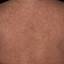 36. Eczema on the Body Pictures