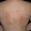 41. Eczema on the Body Pictures