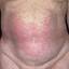 49. Eczema on the Body Pictures