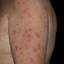 7. Eczema on the Body Pictures