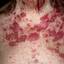 8. Eczema on the Body Pictures
