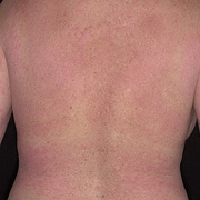 Eczema on the Back