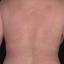 1. Eczema on the Back Pictures