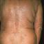 10. Eczema on the Back Pictures