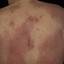 13. Eczema on the Back Pictures
