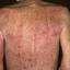 17. Eczema on the Back Pictures