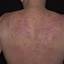 19. Eczema on the Back Pictures