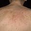 2. Eczema on the Back Pictures