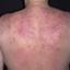 22. Eczema on the Back Pictures