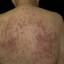 24. Eczema on the Back Pictures
