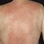 25. Eczema on the Back Pictures