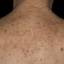 26. Eczema on the Back Pictures