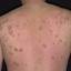 3. Eczema on the Back Pictures