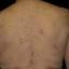 31. Eczema on the Back Pictures